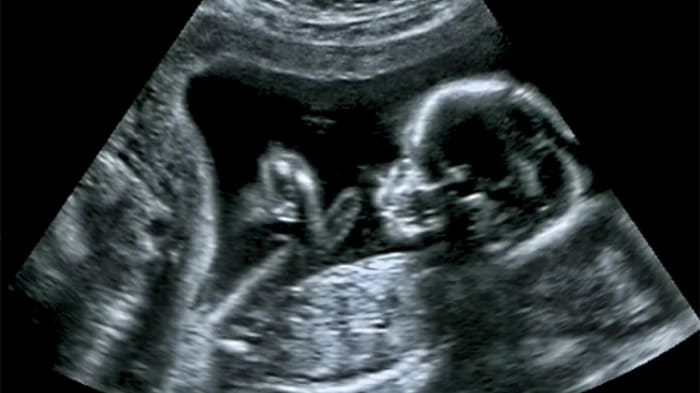 До яких тижнів можна робити аборт До яких тижнів можна робити аборт